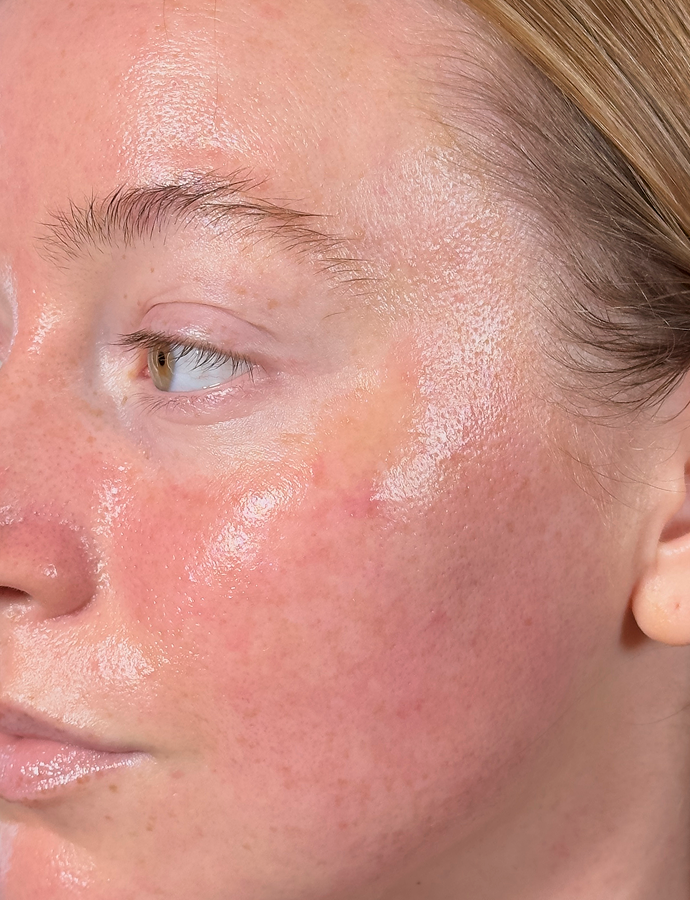 Chemical Peel