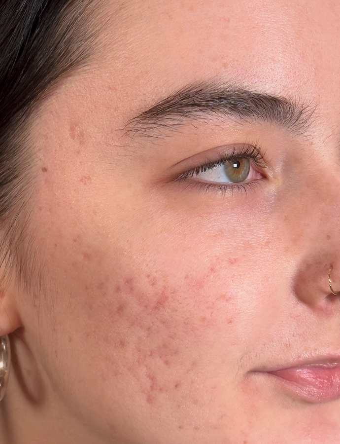 Microneedling