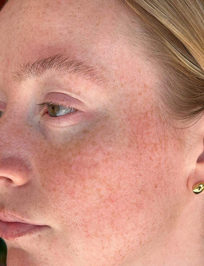 Chemical Peel
