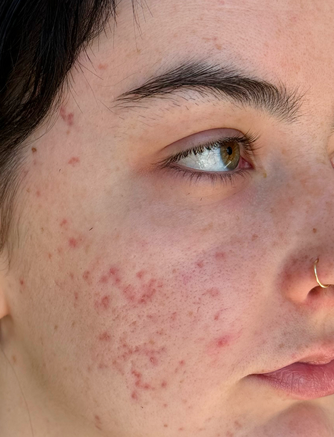 Microneedling