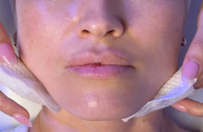 Chemical Peel