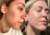 Clear Skin Facial