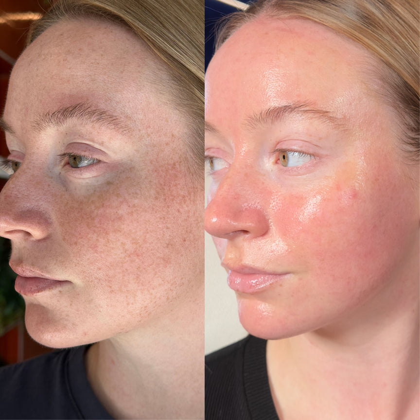 Even-Tone Facial