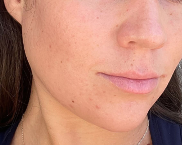Hi Skin result2