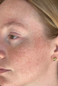 Before Dark Spots