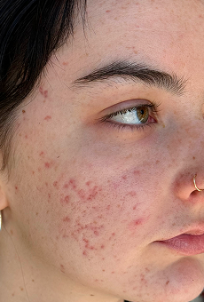 Before breakouts + hyperpigmentation