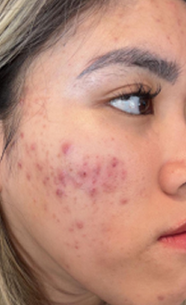 Before Breakouts + Hyperpigmentation