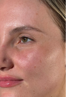 Before preventative aging/hydration