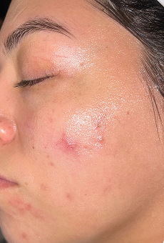 After breakouts