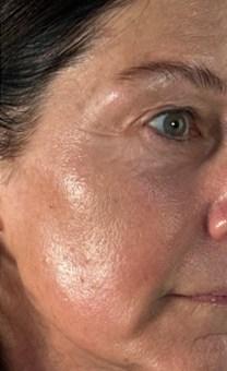 After Aging