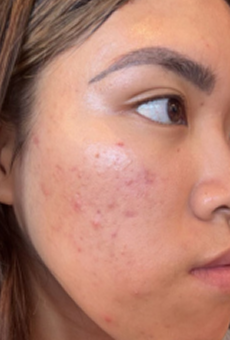 After Breakouts + Hyperpigmentation
