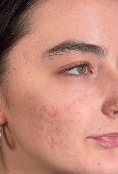 After breakouts + hyperpigmentation