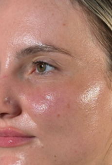After preventative aging/hydration