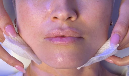 Hi SkinHome treatments section image for Hi Skin