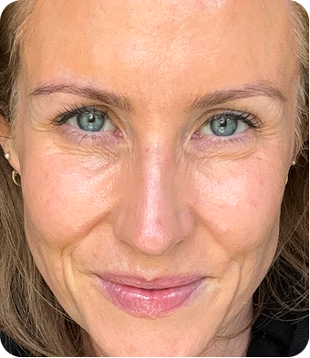 Hi Skin story 4